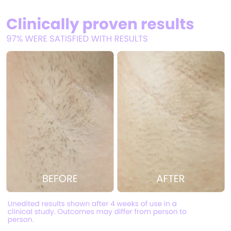 Flair Pro 2.0 SmoothSkin Hair Remover
