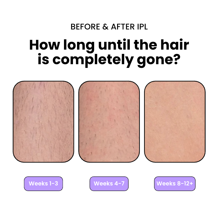 Flair Pro 2.0 SmoothSkin Hair Remover