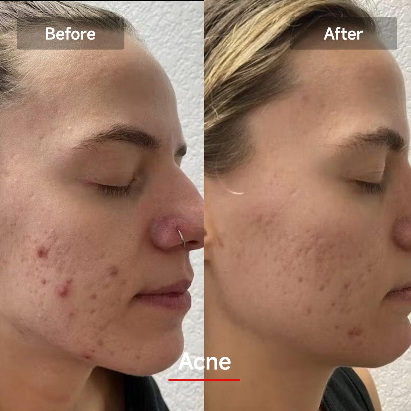 RadianceRenew™ LED Face Therapy Mask