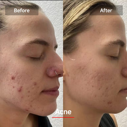 RadianceRenew™ LED Face Therapy Mask